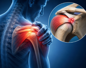 Supraspinatus Tendinitis: Diagnosis, Treatment & Recovery Guide