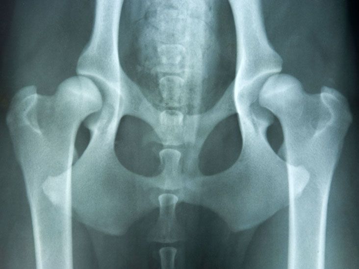 Developmental Dysplasia of the Hip