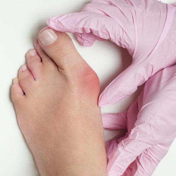 Hallux Valgus