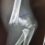 Supracondylar Fracture of the Humerus