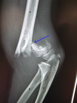 Supracondylar Fracture of the Humerus