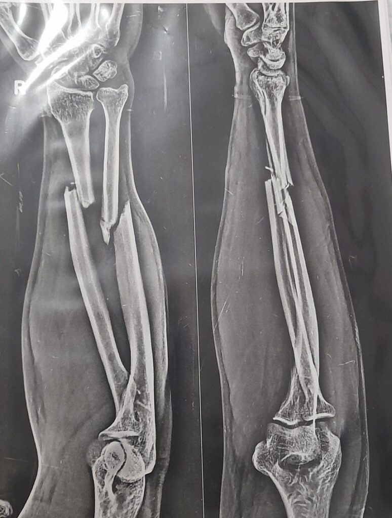 Fracture of the Radius and Ulna