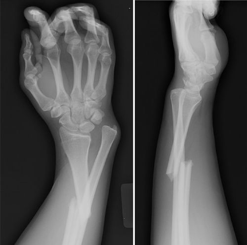 Galeazzi Fracture