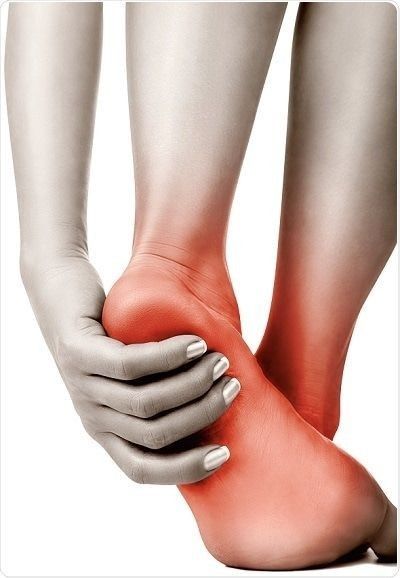 Plantar Fasciitis