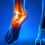 Calcaneal Bursitis: Understanding Heel Pain and Its Rehabilitation