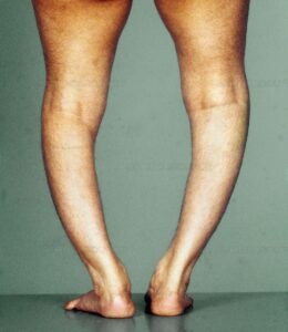 Why Children Develop Bow Legs and How It Can Be Treated