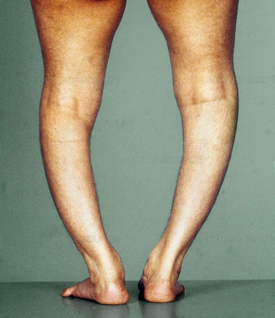 Bow Legs