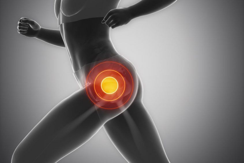 Trochanteric Bursitis