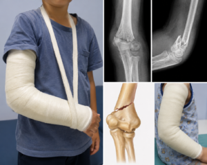 Supracondylar Fracture of the Humerus