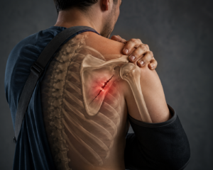 Fracture of the Scapula: Mechanism of Injury and Functional Recovery