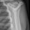 Posterior Dislocation of the Shoulder Joint