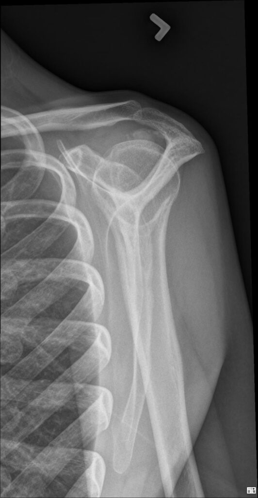 Posterior Dislocation of the Shoulder Joint