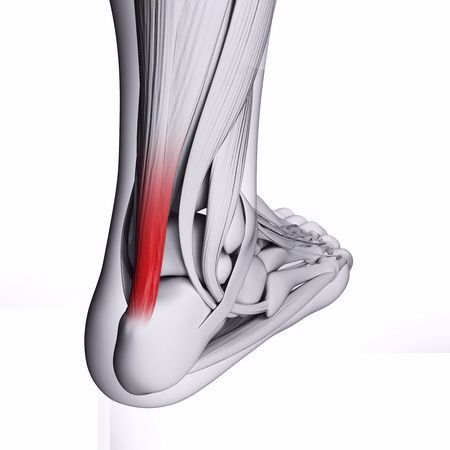 Tendo-Achilles Tendon Ruptur