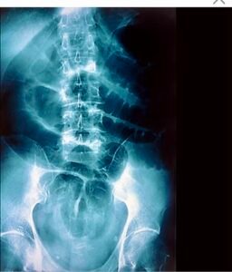 Understanding Vertebral Anomalies: A Physiotherapy Perspective