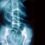 Understanding Vertebral Anomalies: A Physiotherapy Perspective