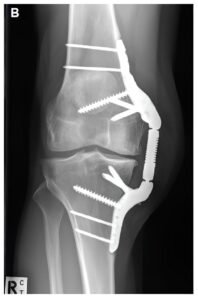 Fracture of the Patella: From Trauma to Mobility