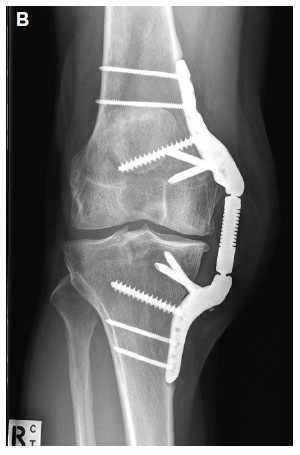 Fracture of the Patella: From Trauma to Mobility