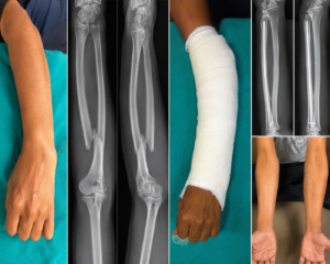 Colles’ Fracture: From Injury to Functional Recovery