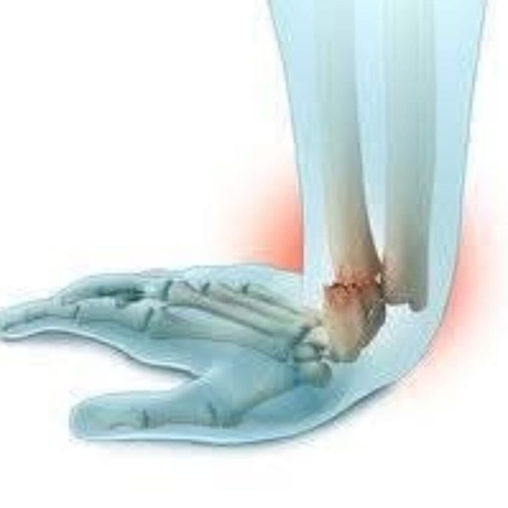 Colles’ Fracture