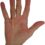 Understanding Dupuytren’s Contracture: A Progressive Hand Disorder