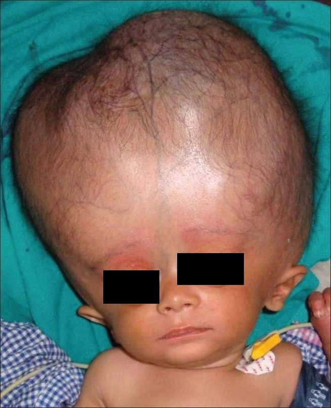 Hydrocephalus
