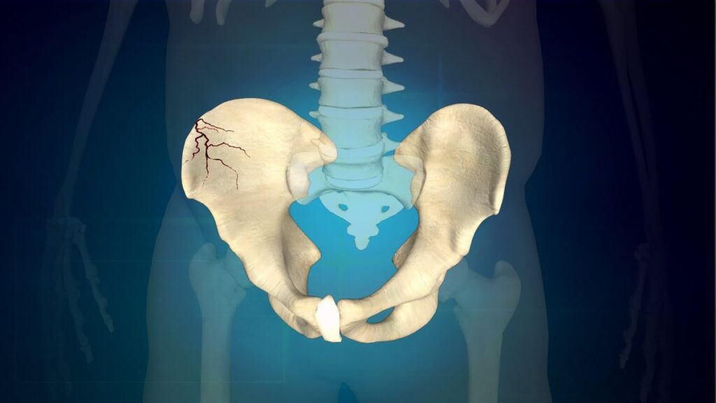 Fracture of the Pelvis