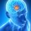 Brain Tumors: Causes, Clinical Features, and Rehabilitation Approach