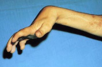 Volkmann’s Ischemic Contracture: A Clinical Overview and Rehabilitation Approach