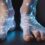 Focal Neuropathy: From Nerve Damage to Recovery