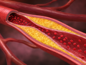 Atheroma: Clinical Features and Management Approach