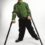 Crutch Palsy: Causes, Clinical Features, and Rehabilitation Approach