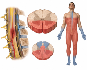 Anterior Cord Syndrome: Key Features and Physiotherapy Approach