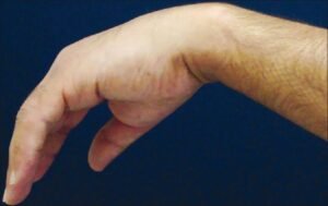 From Wrist Drop to Recovery: A Guide to Radial Nerve Injury