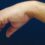 From Wrist Drop to Recovery: A Guide to Radial Nerve Injury