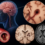 Lacunar Syndromes: A Complete Guide to Small Vessel Stroke