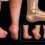 Talipes Calcaneovalgus Deformity: Causes, Symptoms, and Physiotherapy Management